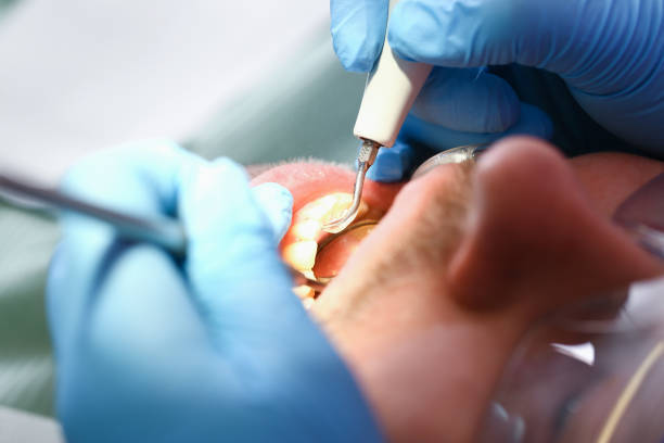 Best Emergency Tooth Extraction in Williston, SC